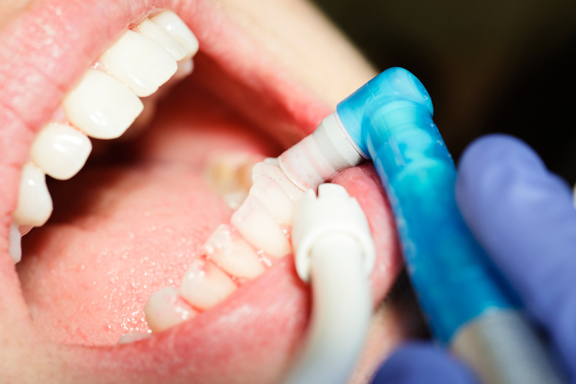 Dental Cleaning Close-up