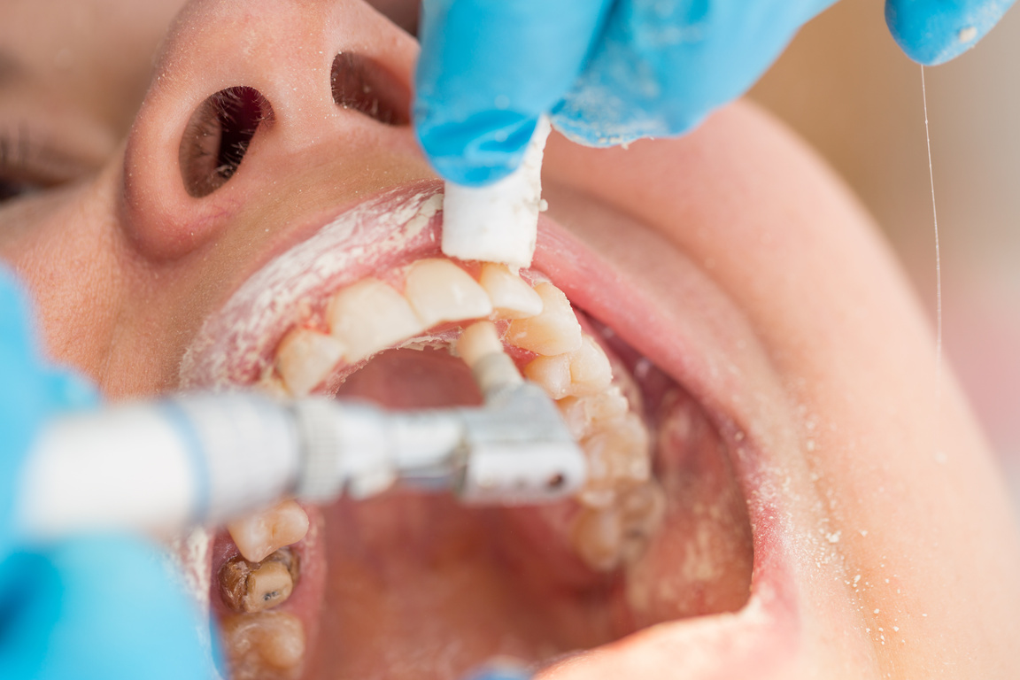 Dental Pumice Cleaning Procedure Close-up